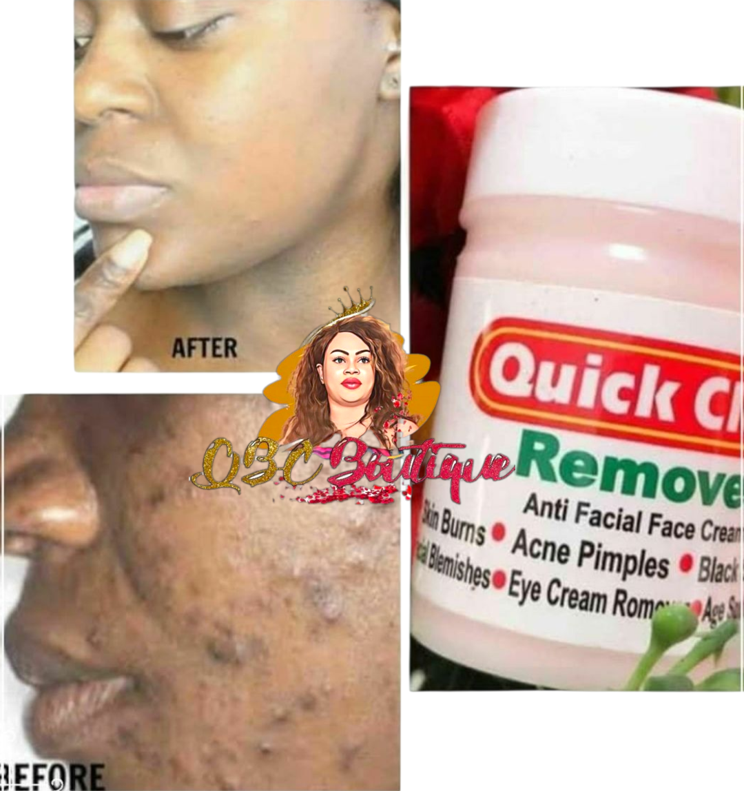 Quick Clear Face Cream Clears, Sunburn, spots, and facial Blemishes